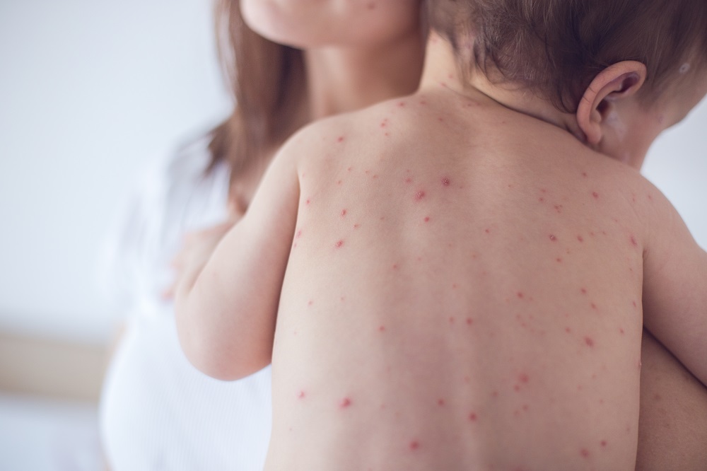 3 things you need to know about measles maternity and infant family